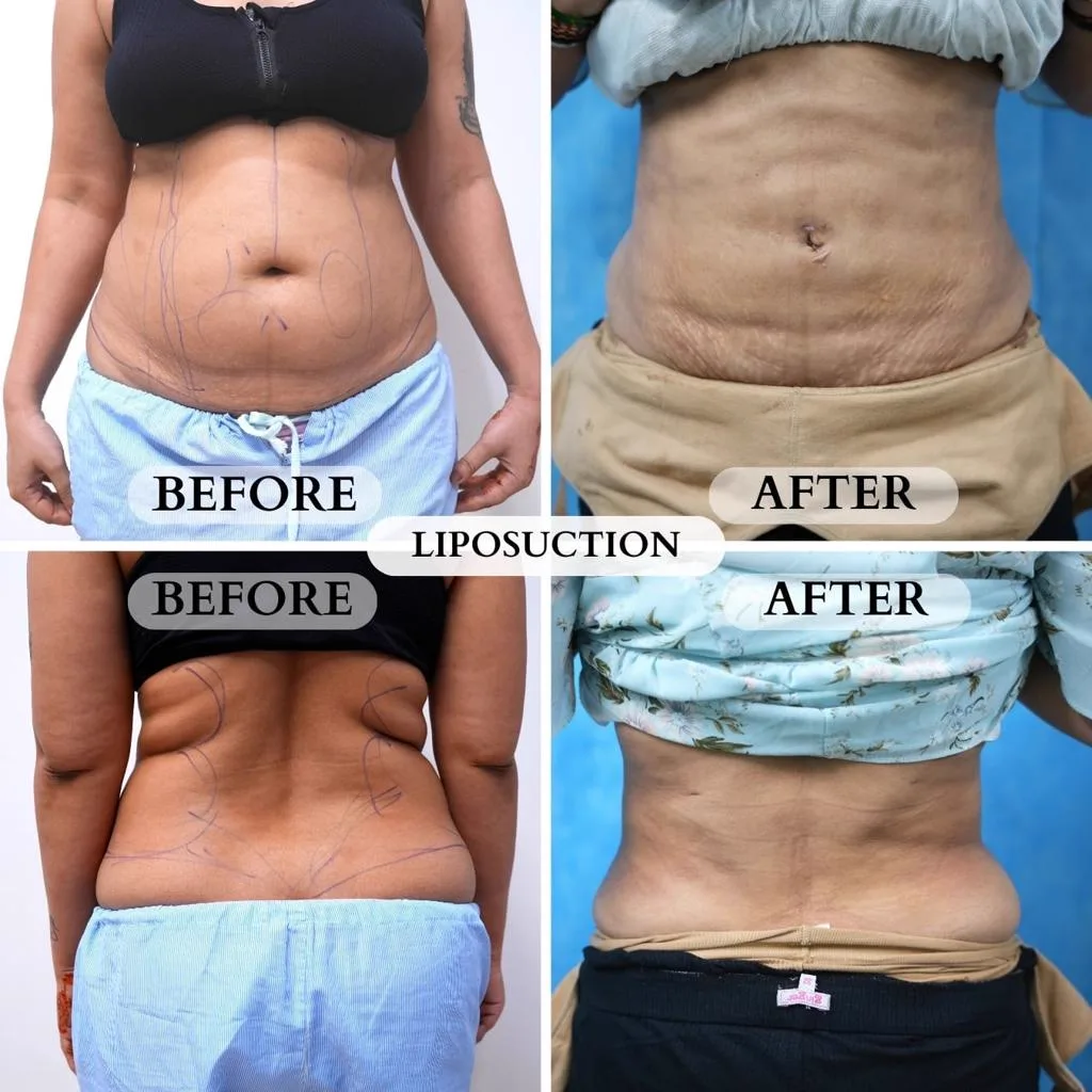 5. Liposuction with Fat Transfer image 2