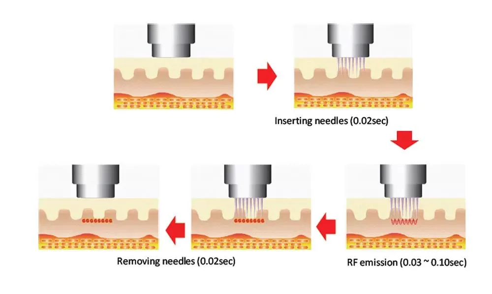 1. MNRF (Microneedling Radiofrequency) in Guwahati image 2