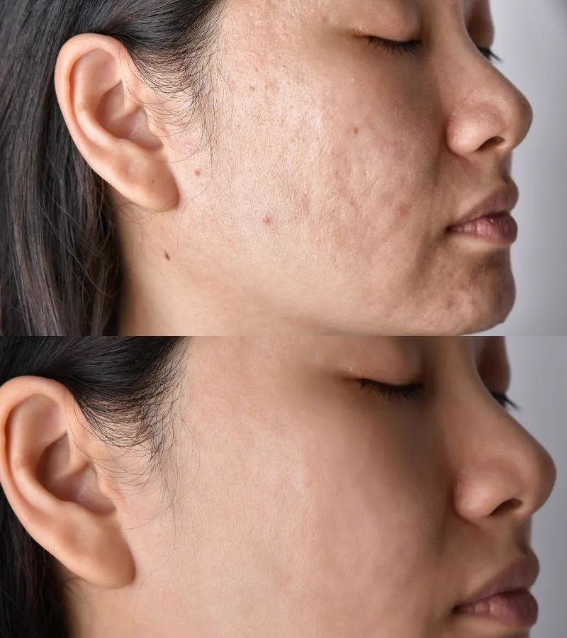 1. MNRF (Microneedling Radiofrequency) in Guwahati image 3