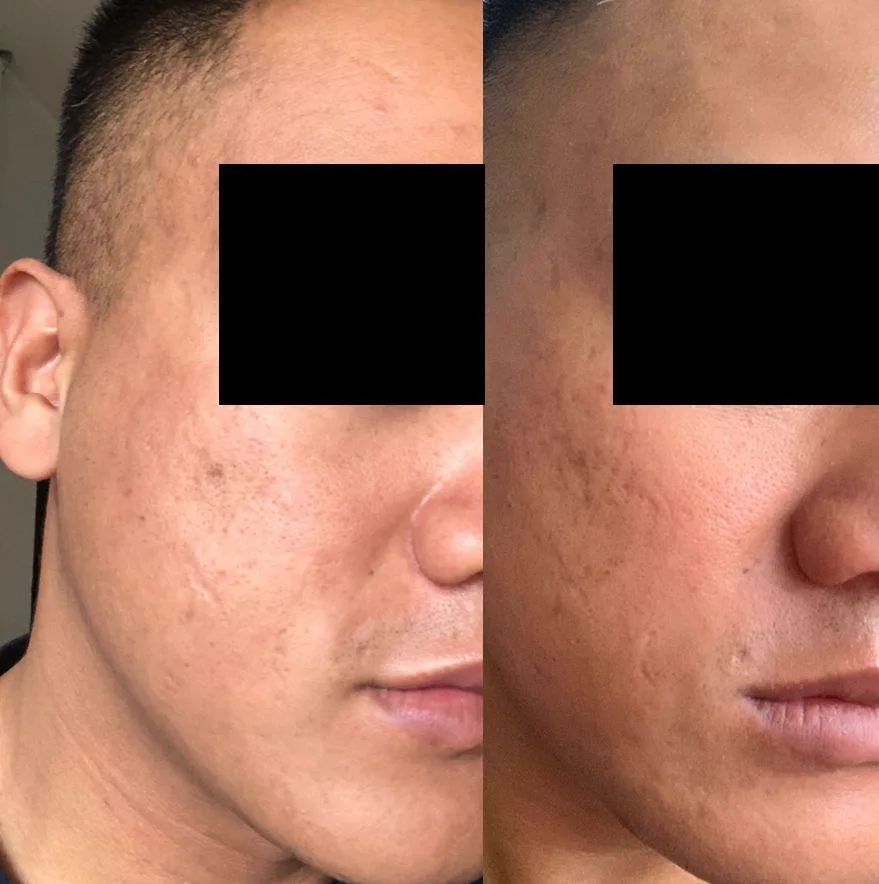 2. MNRF for Acne Scars image 1