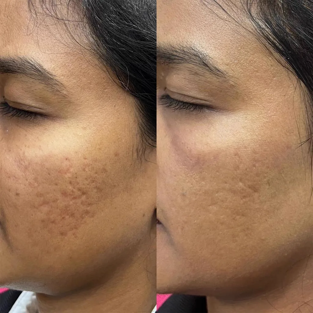 2. MNRF for Acne Scars image 2