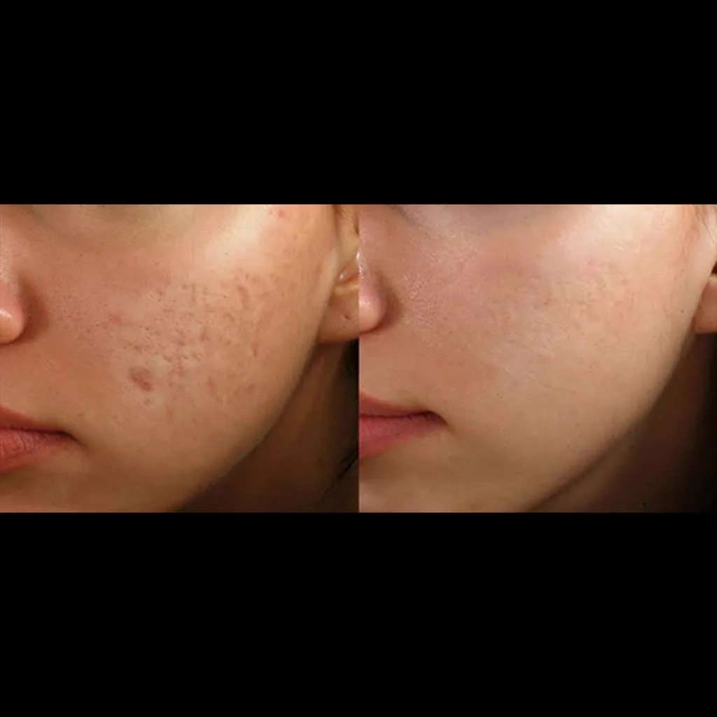 3. MNRF for Open Pores & Skin Texture image 1