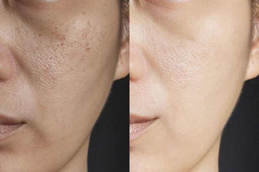 3. MNRF for Open Pores & Skin Texture image 3