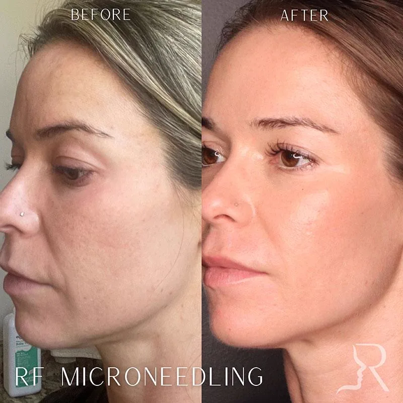 4. MNRF for Pigmentation & Skin Rejuvenation image 1