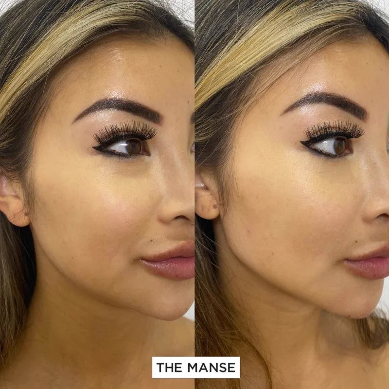 5. Masculinization / Feminization of Jawline image 1