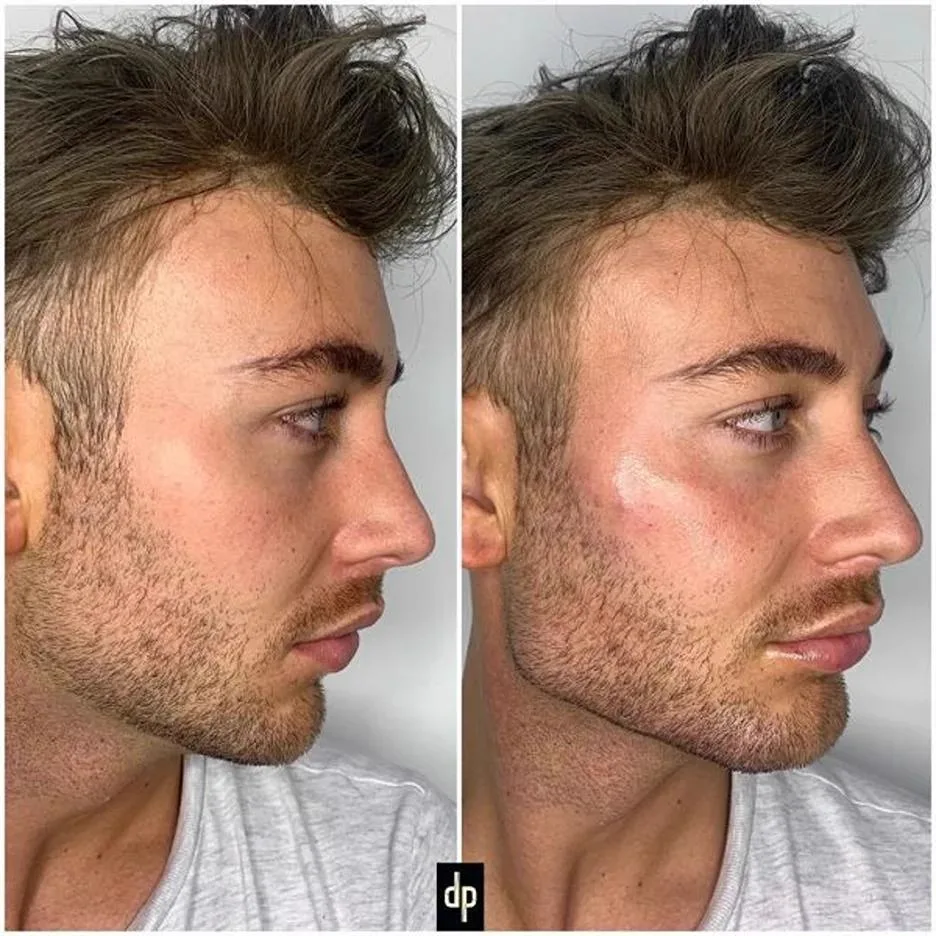 5. Masculinization / Feminization of Jawline image 2