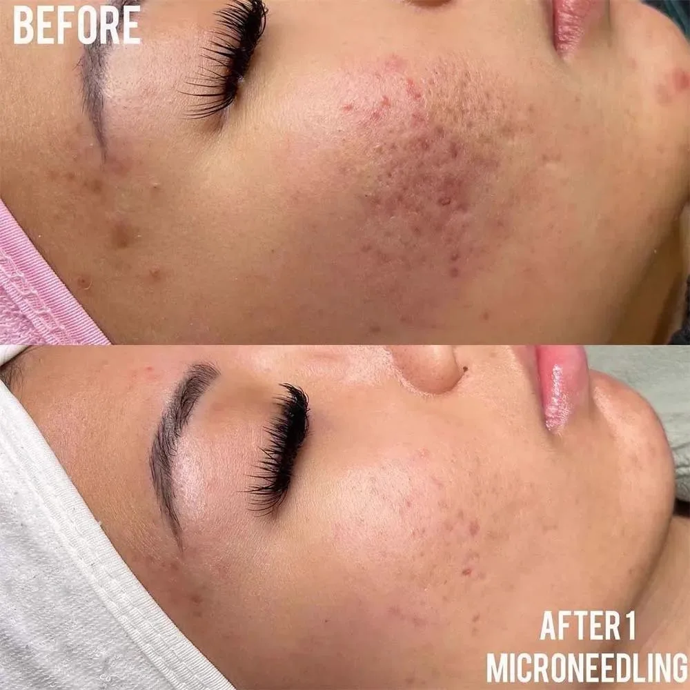 2. Microneedling (Collagen Induction Therapy) image 1