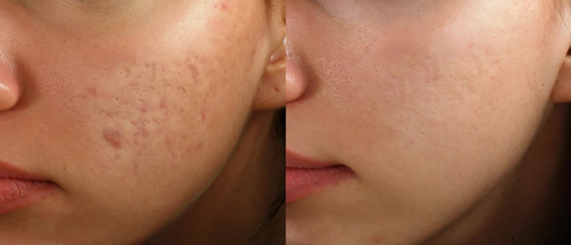 2. Microneedling (Collagen Induction Therapy) image 2