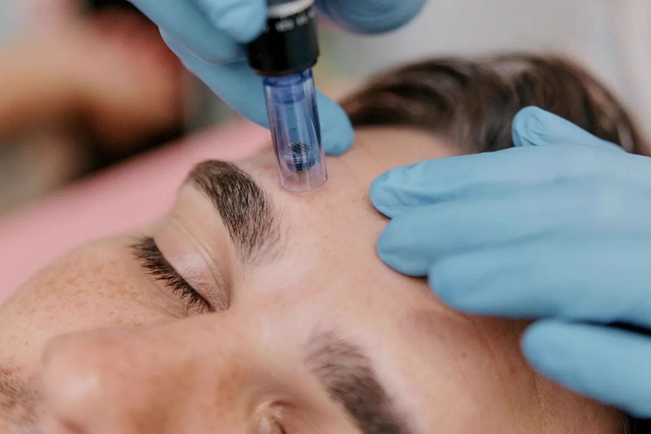 2. Microneedling (Collagen Induction Therapy) image 3