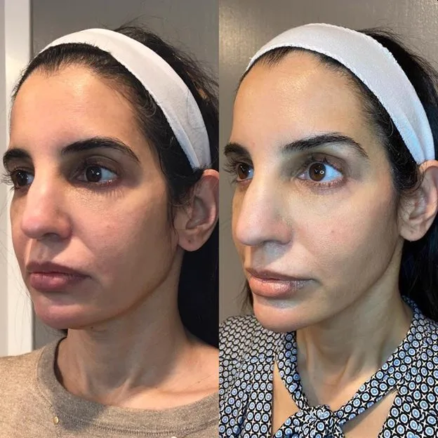 3. Mid-Face & Cheek Lift image 2