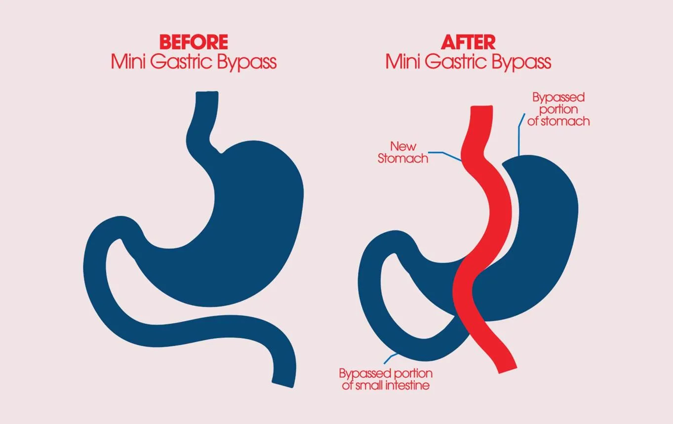 3. Mini Gastric Bypass (MGB) image 1