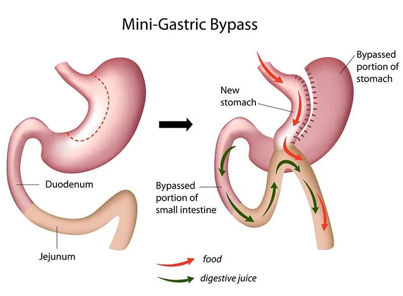 3. Mini Gastric Bypass (MGB) image 2