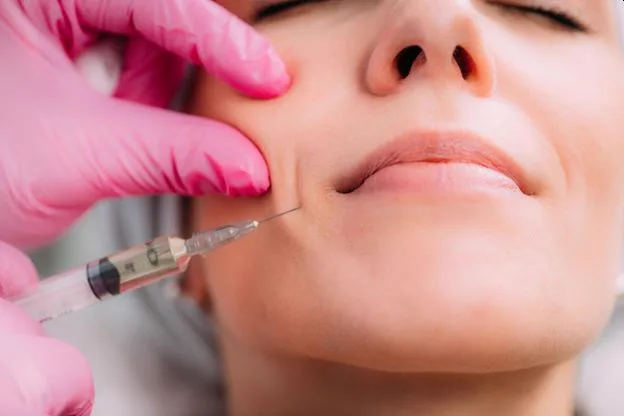 5. Nasolabial Fold & Smile Line Fillers image 1