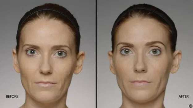 5. Nasolabial Fold & Smile Line Fillers image 2