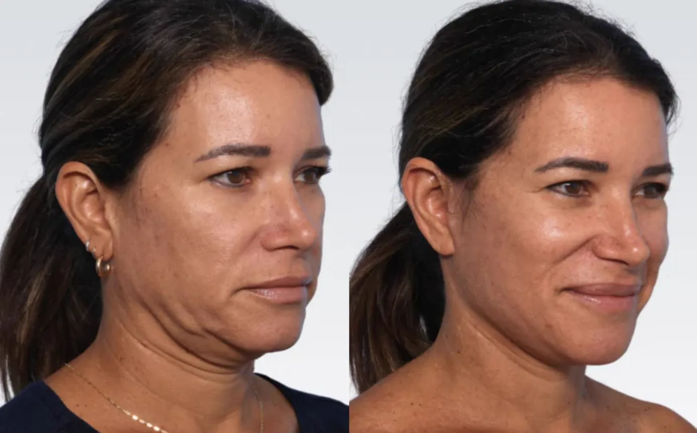 3. Neck Lift (Lower Face & Neck Contouring) image 1