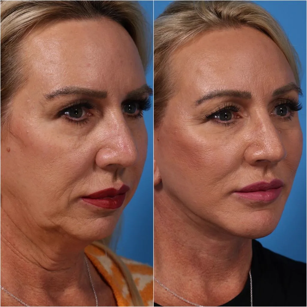 3. Neck Lift (Lower Face & Neck Contouring) image 2