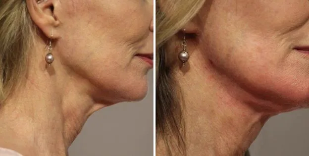 4. Neck Thread Lift image 1