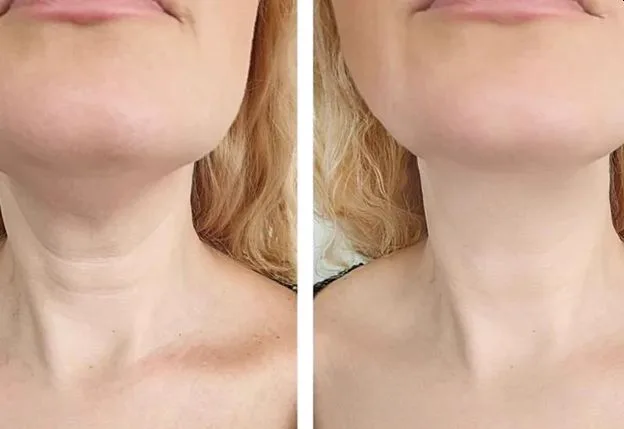 4. Neck Thread Lift image 2