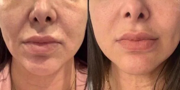 3. Neck Tightening (Turkey Neck Treatment) image 1