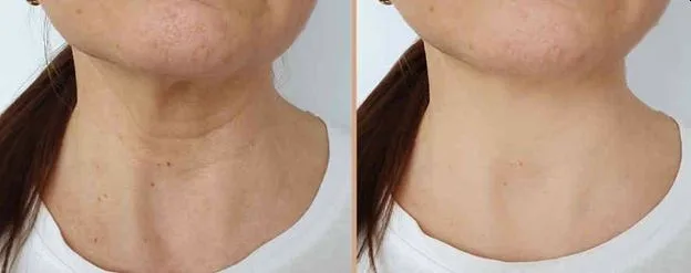 3. Neck Tightening (Turkey Neck Treatment) image 2