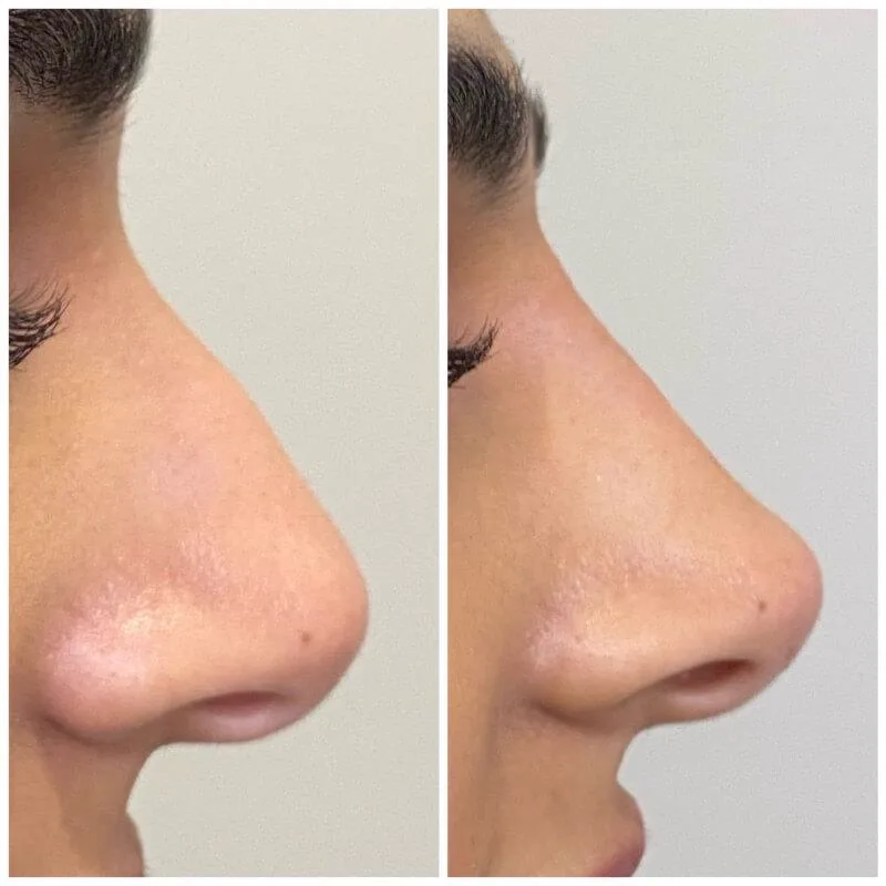 1. Non-Surgical Rhinoplasty (Liquid Nose Job) image 1