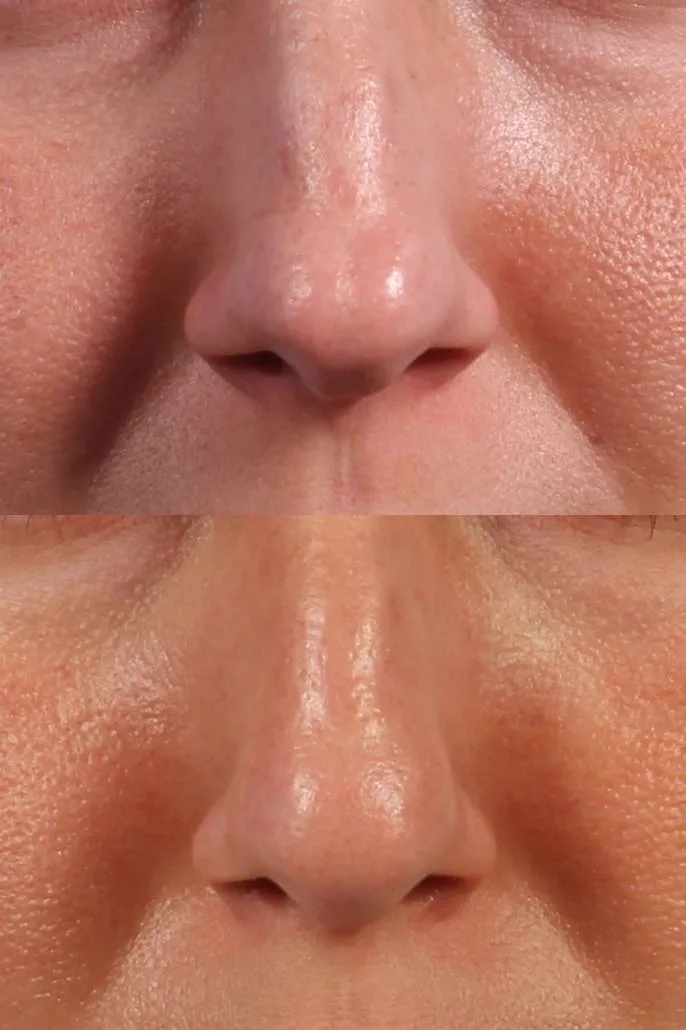2. Nose Bridge Enhancement image 1