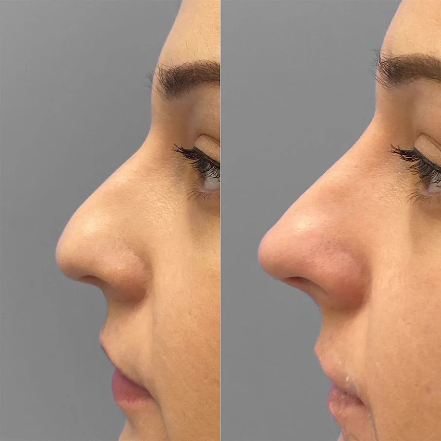 2. Nose Bridge Enhancement image 3