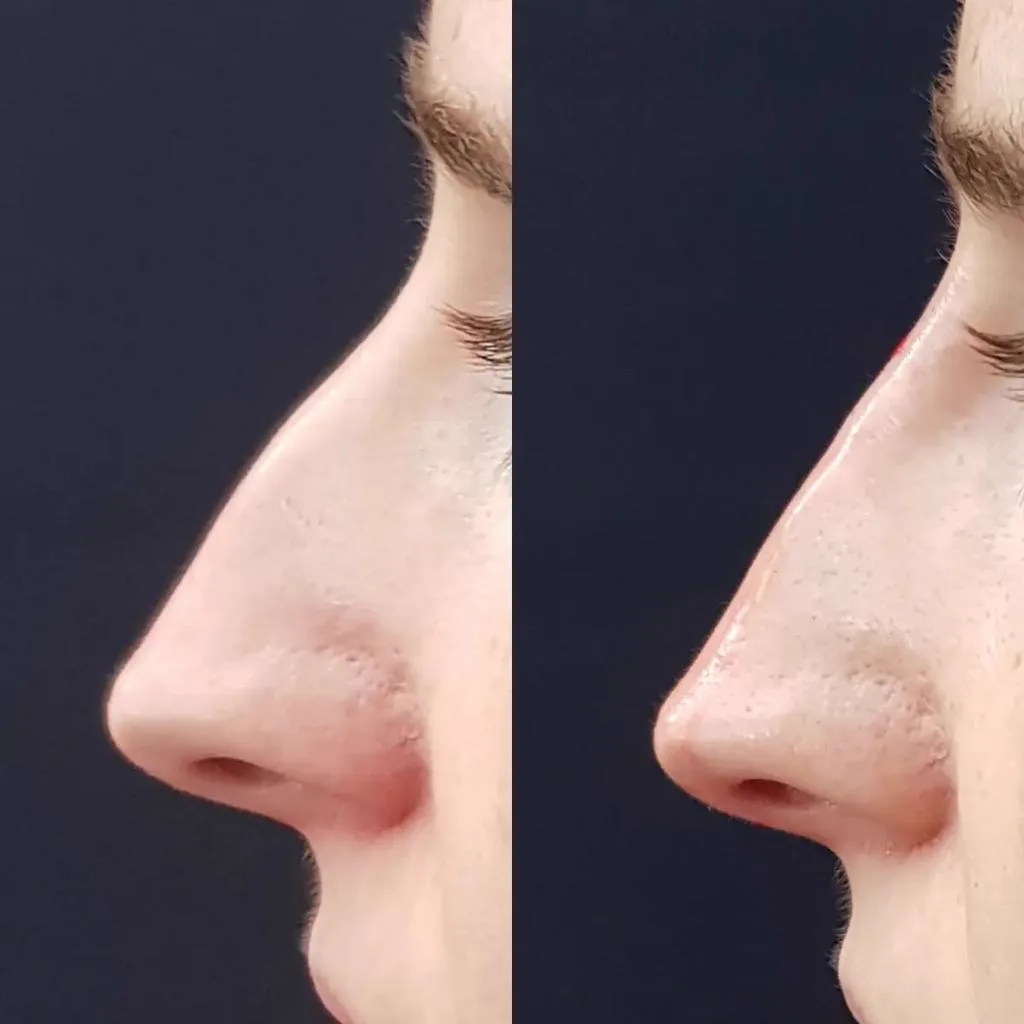 5. Nose Symmetry & Profile Balancing image 1