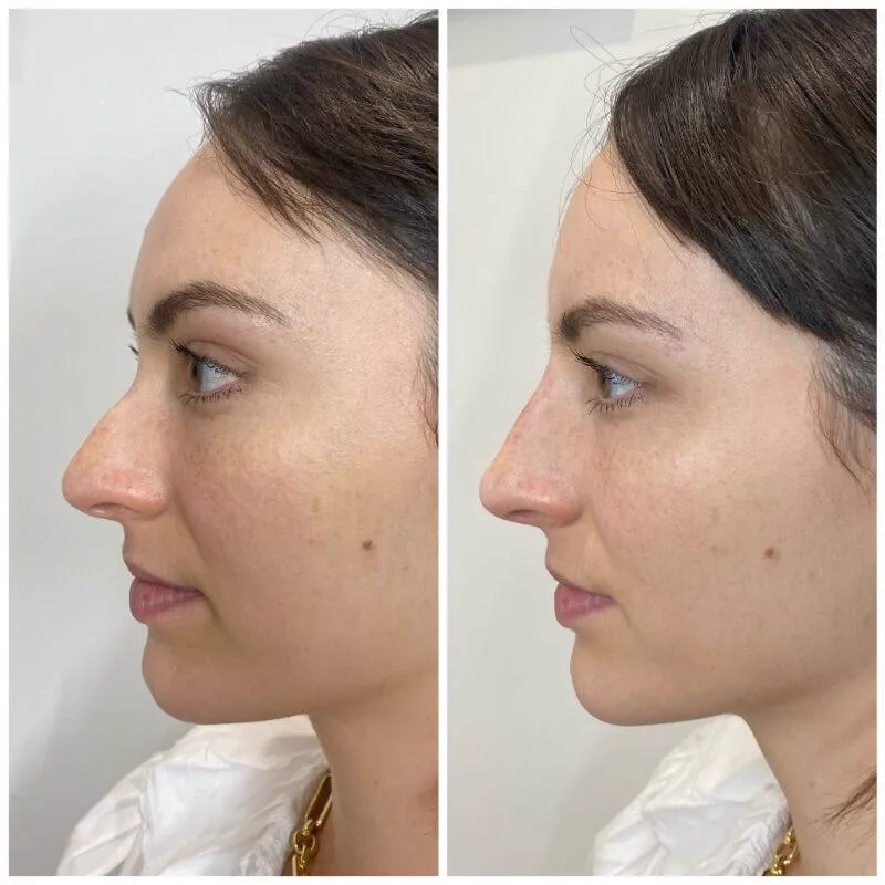 3. Nose Tip Correction image 1