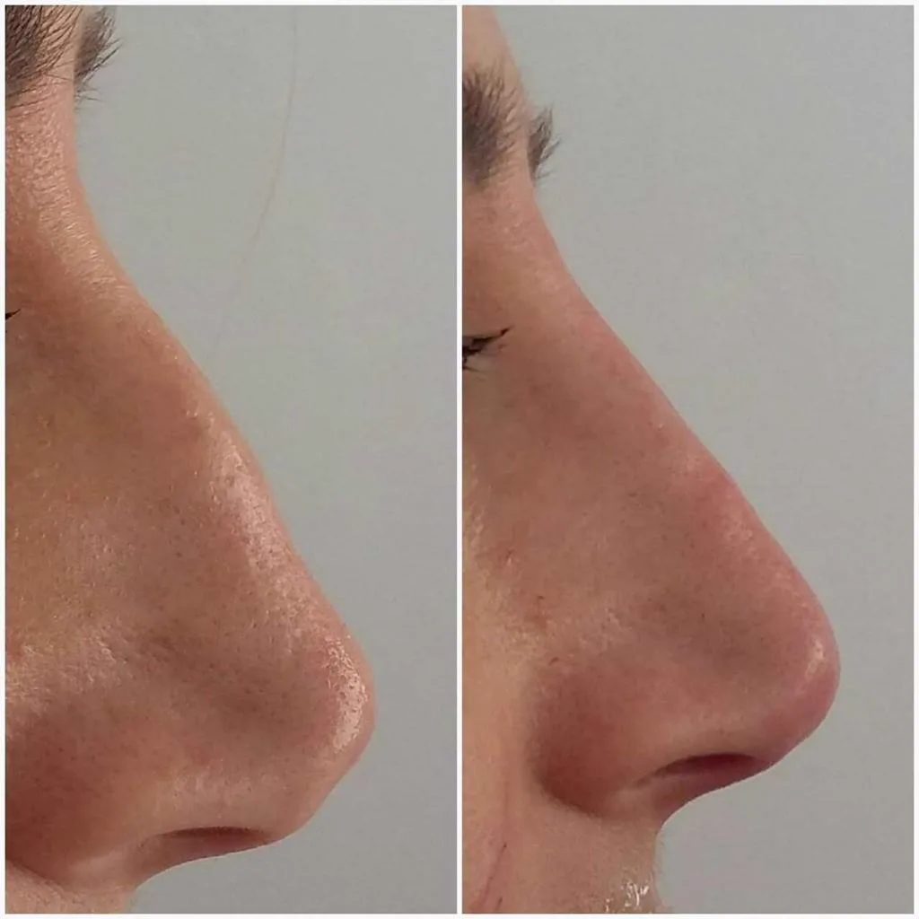 3. Nose Tip Correction image 3