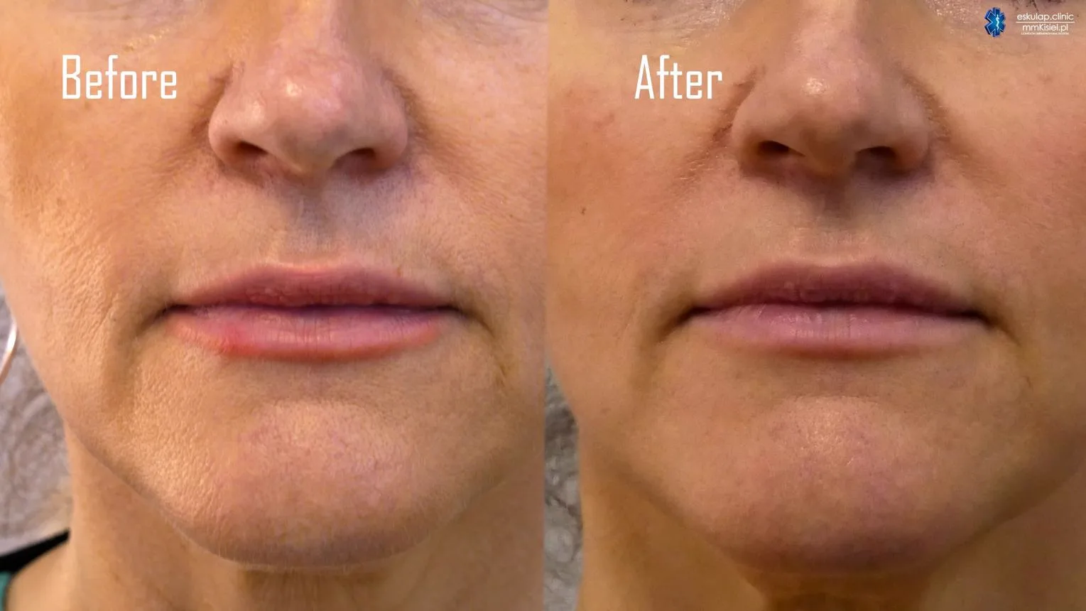 3. PRP Therapy (Platelet-Rich Plasma) image 3