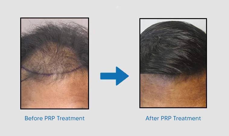6. PRP Therapy for Hair (Adjunct Treatment) image 1