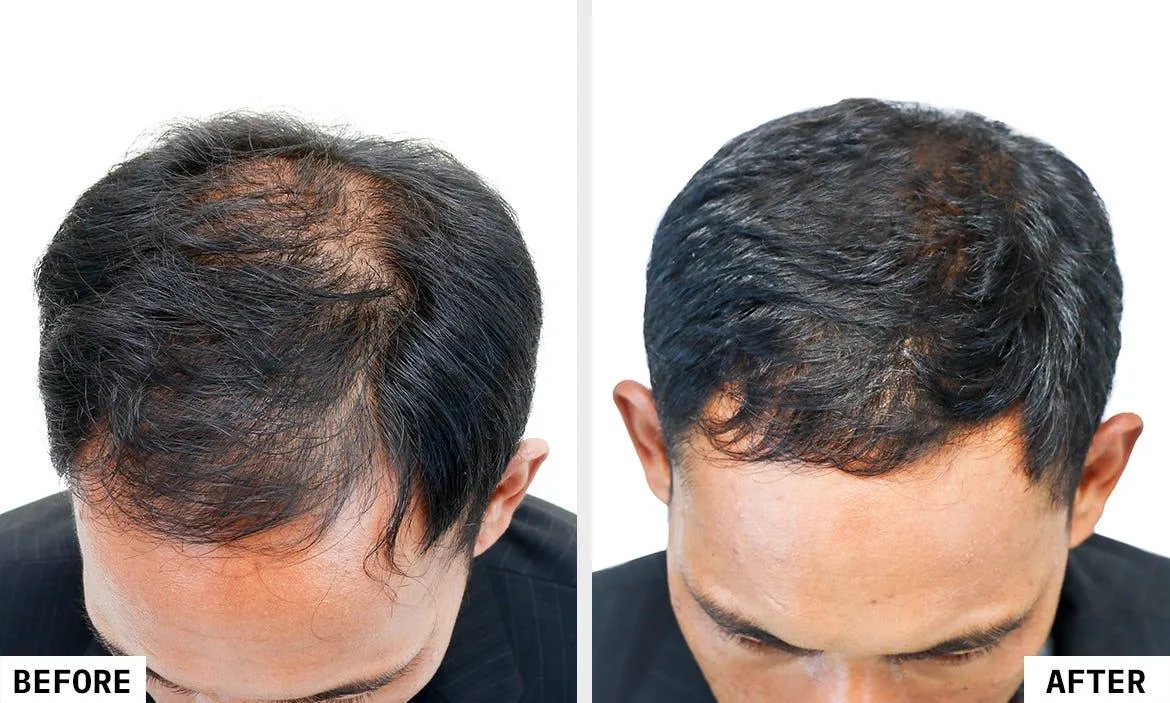 6. PRP Therapy for Hair (Adjunct Treatment) image 2