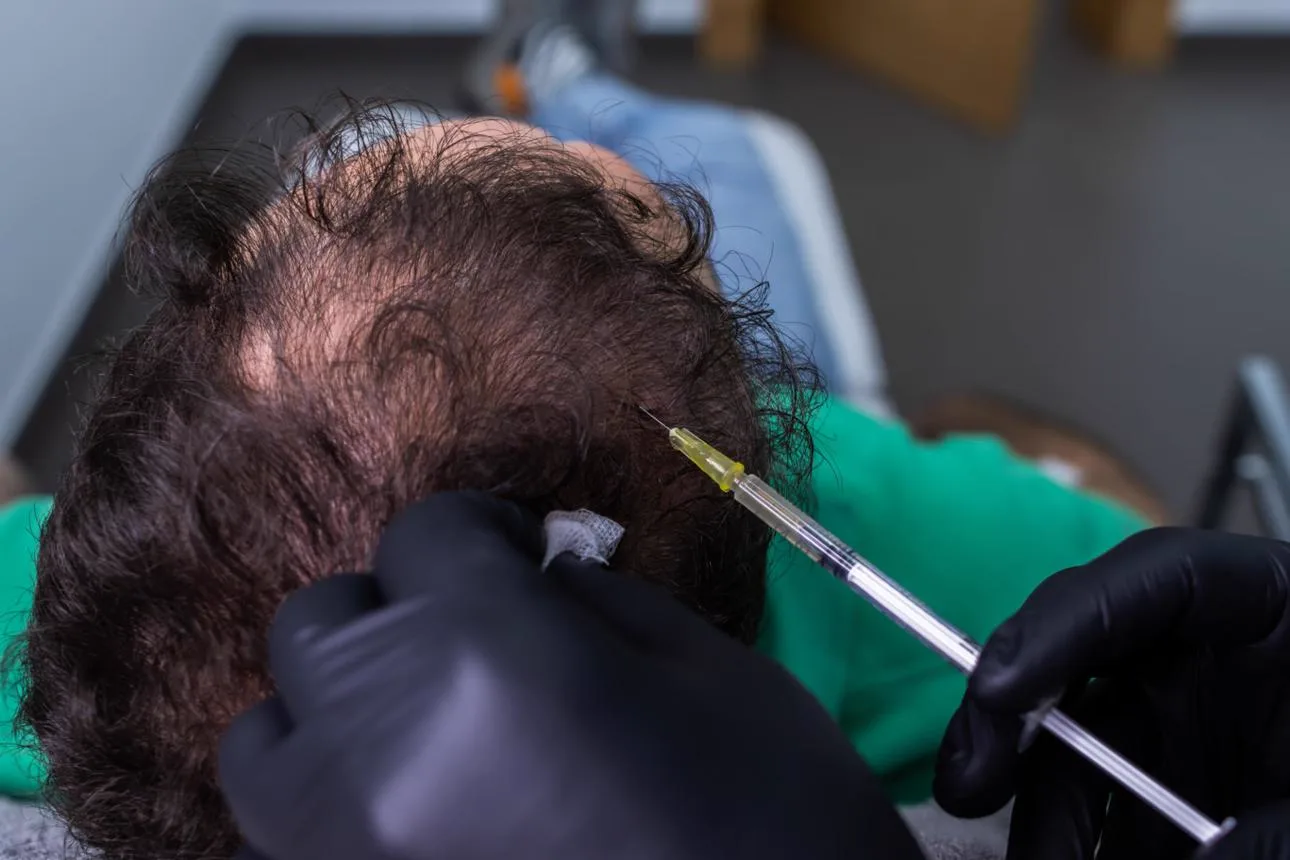 1. PRP Therapy for Hair in Guwahati image 1