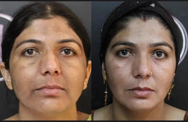4. Pigmentation & Uneven Skin Tone Correction