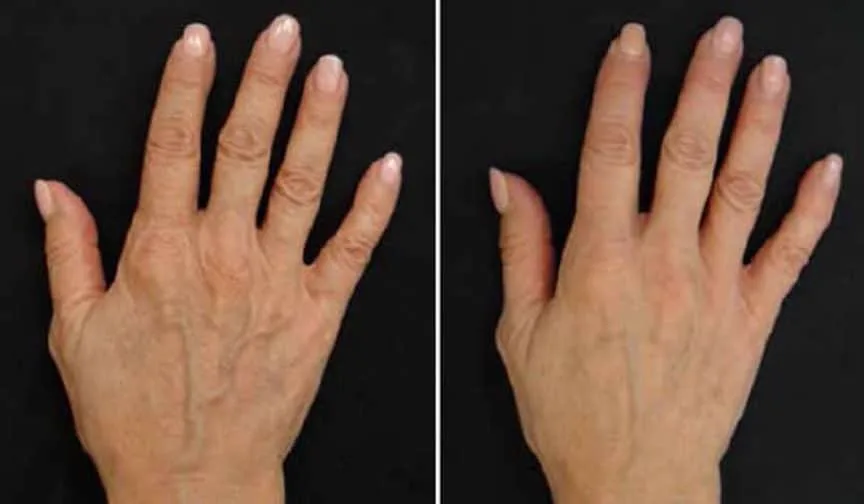 3. Profhilo for Face, Neck & Hands