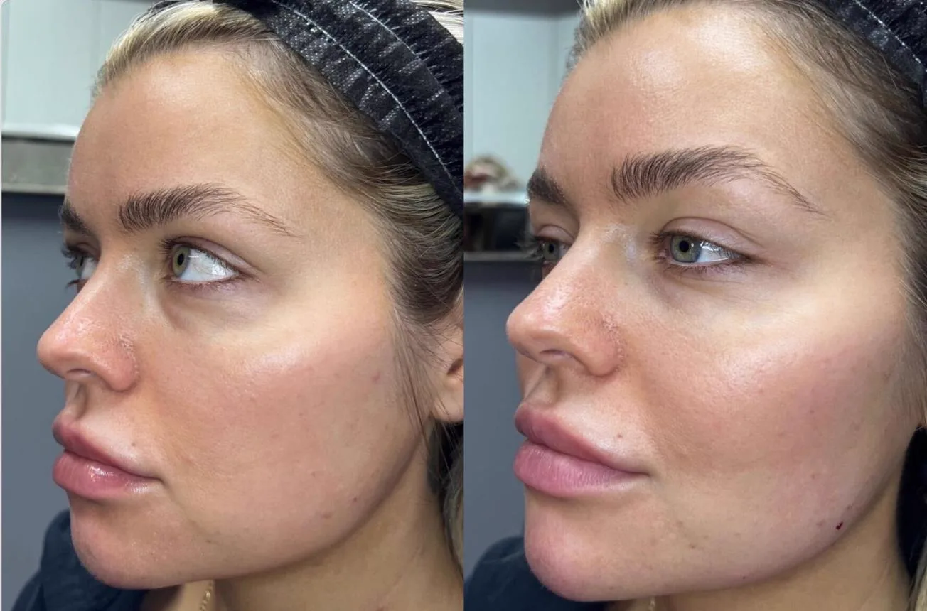 3. Profile Balancing (Chin + Nose + Jawline) image 1