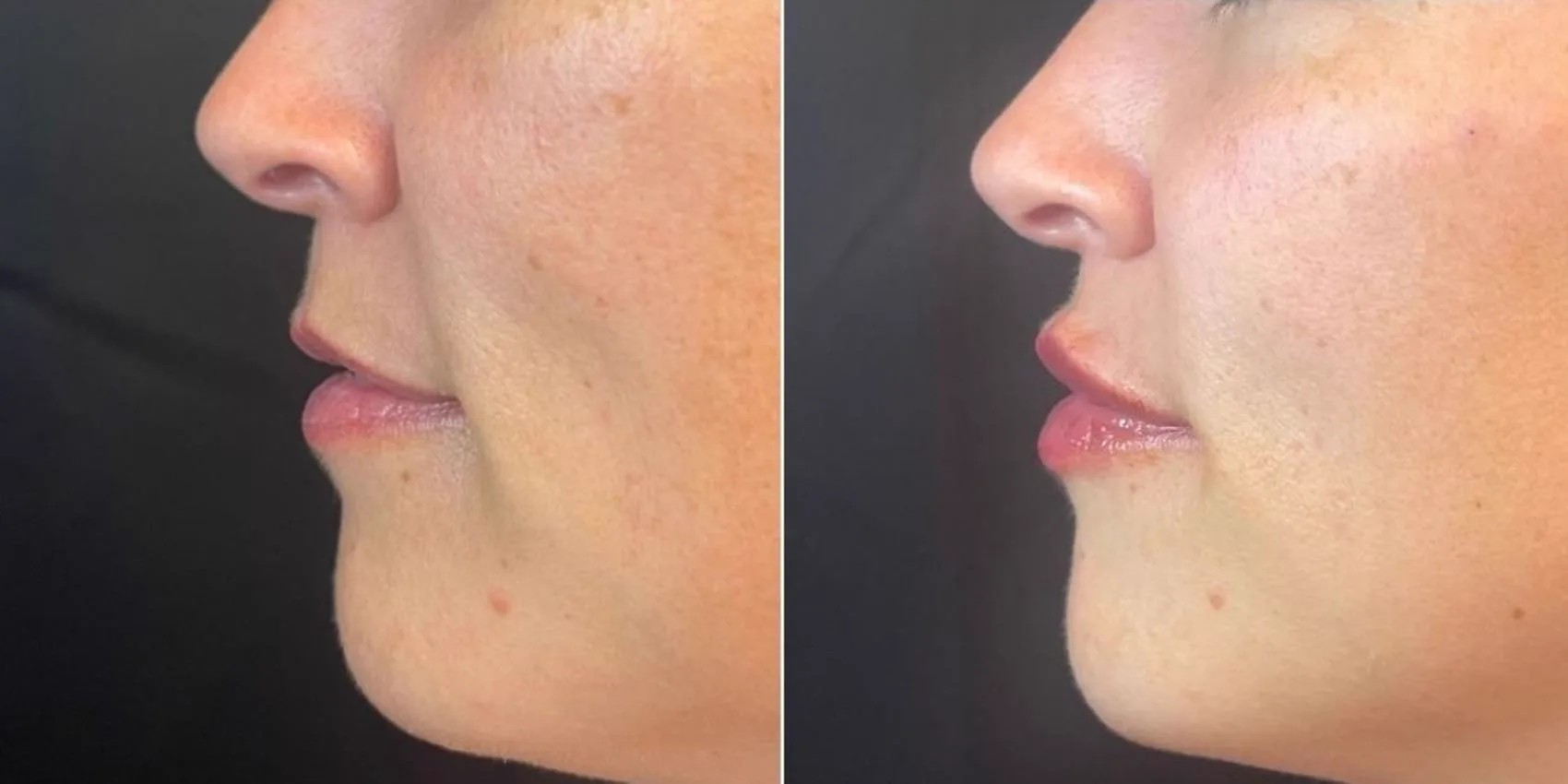 3. Profile Balancing (Chin + Nose + Jawline) image 2