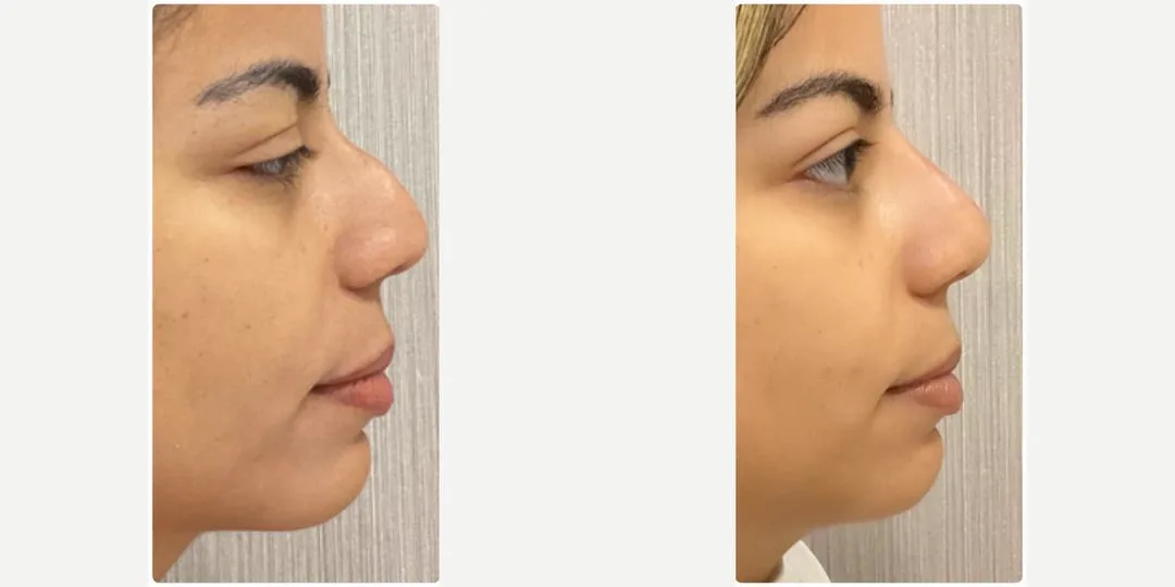 3. Profile Balancing (Chin + Nose + Jawline) image 3