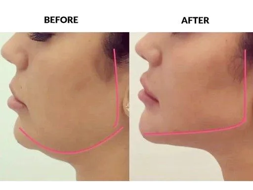 3. Profile Balancing (Jawline + Chin + Nose) image 2