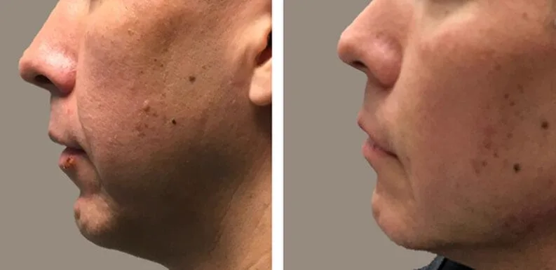 3. Profile Balancing (Jawline + Chin + Nose) image 3