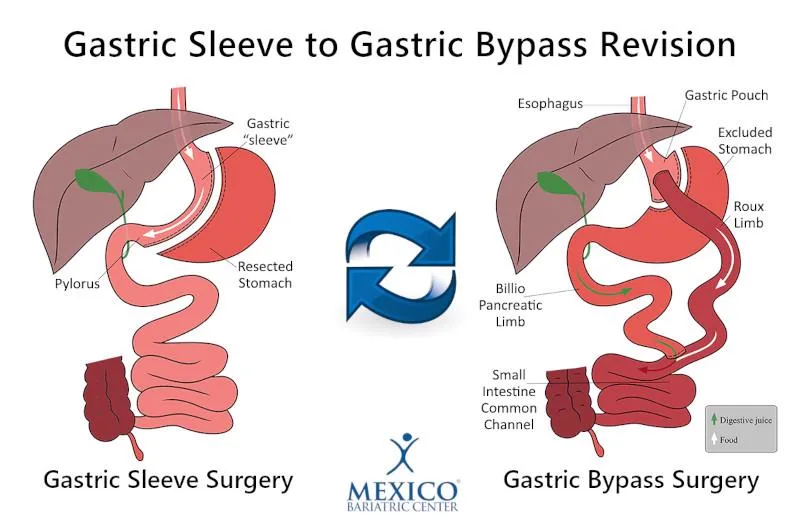 4. Revisional Bariatric Surgery image 2