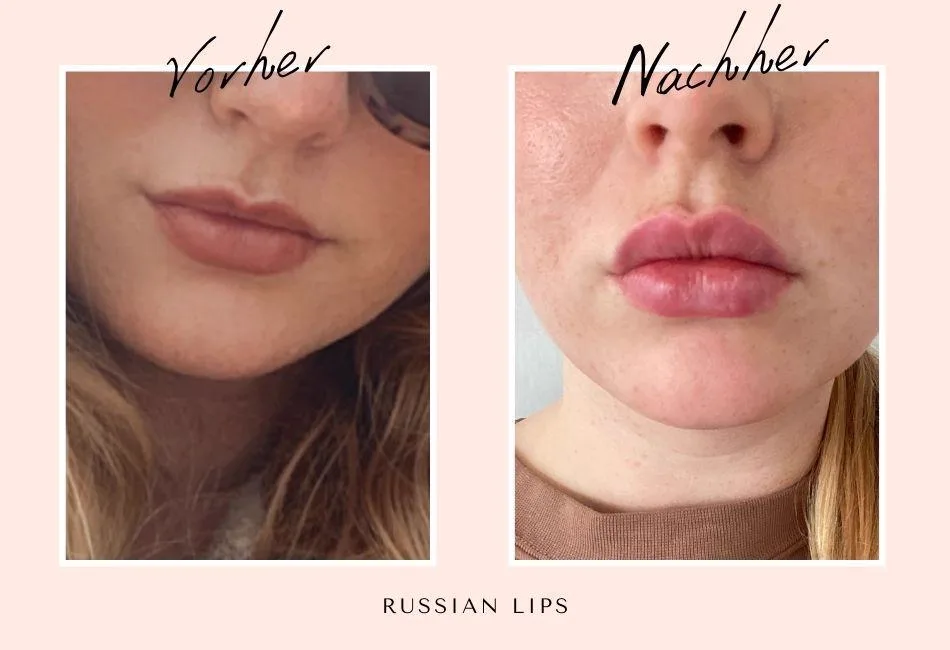 4. Russian Lips Technique image 2