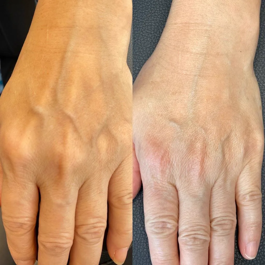 5. Sculptra for Body Areas (Neck, Hands, Buttocks) image 1