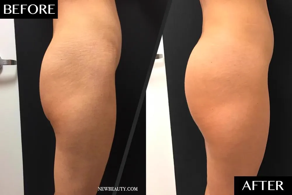 5. Sculptra for Body Areas (Neck, Hands, Buttocks) image 2