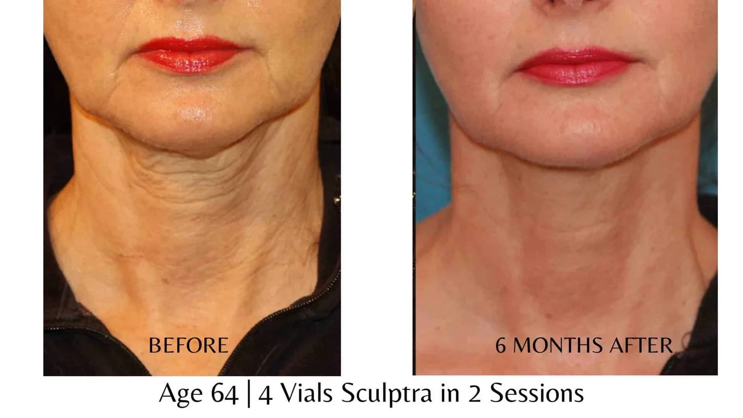 5. Sculptra for Body Areas (Neck, Hands, Buttocks) image 3