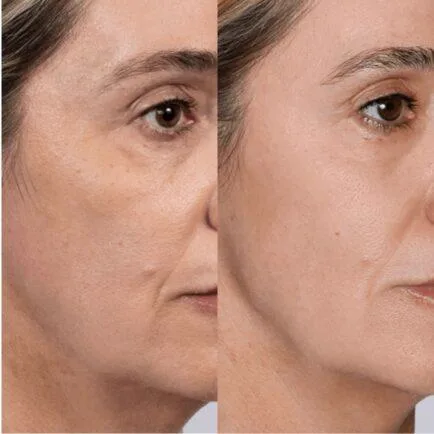 2. Sculptra for Volume Loss & Hollow Areas