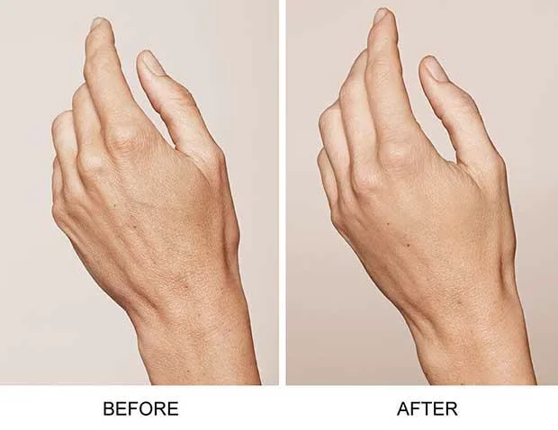 5. Skin Boosters for Neck & Hands image 1
