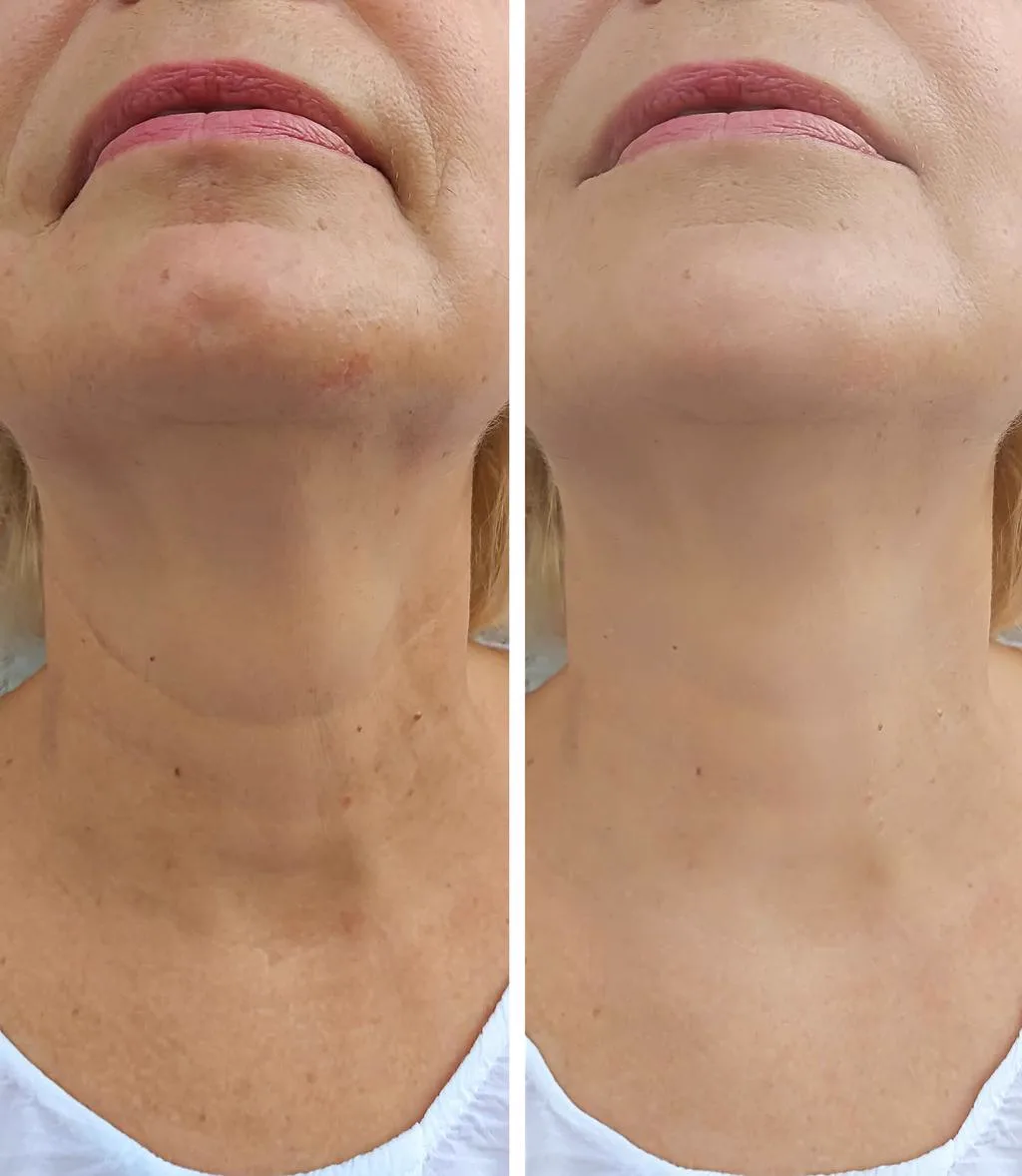 5. Skin Boosters for Neck & Hands image 3
