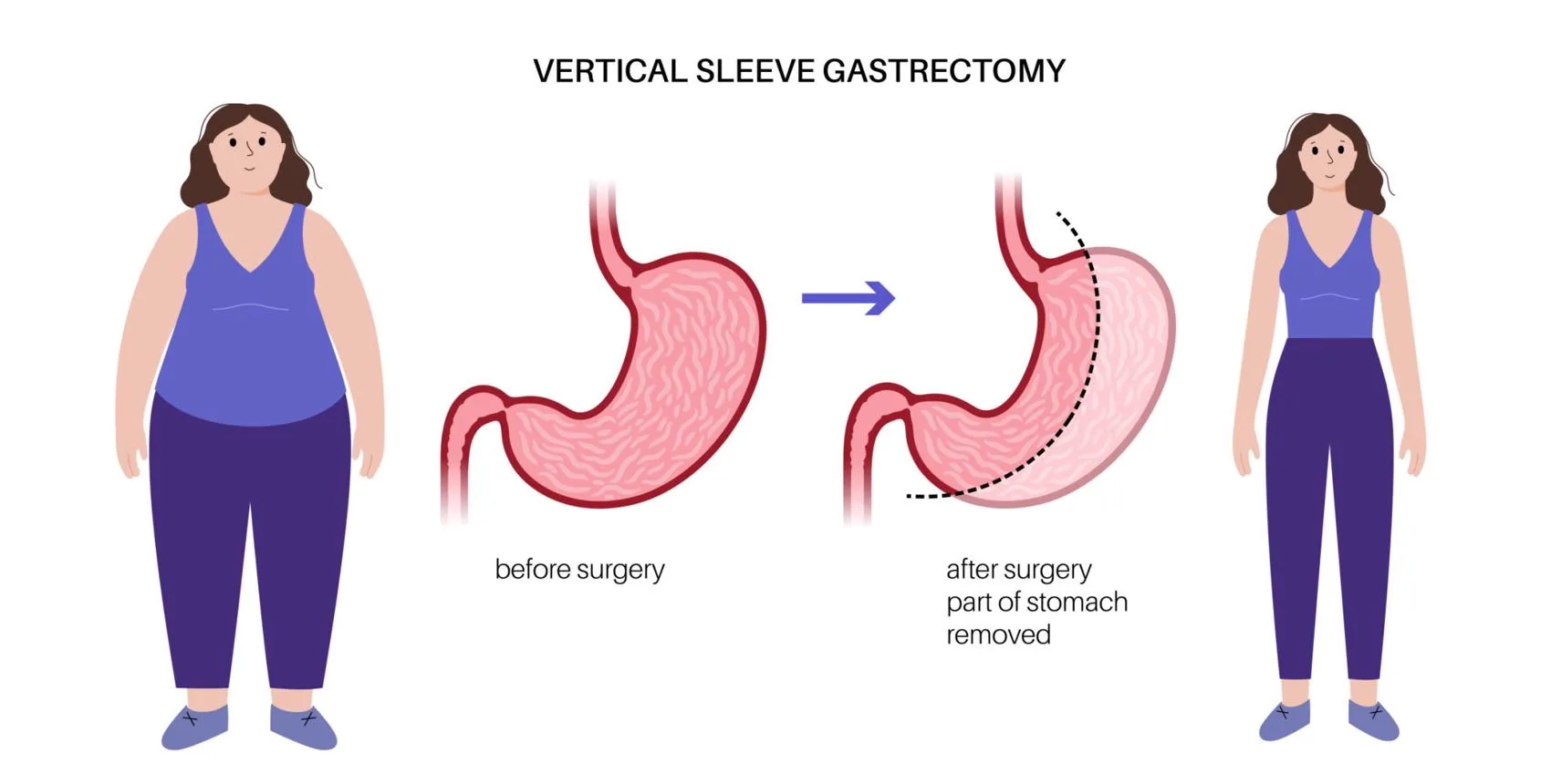 1. Sleeve Gastrectomy in Guwahati image 1